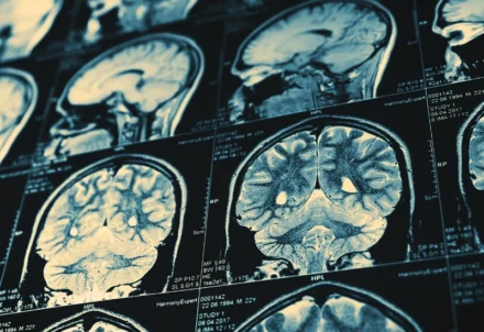 Collection of human brain MRI scans on a monitor.