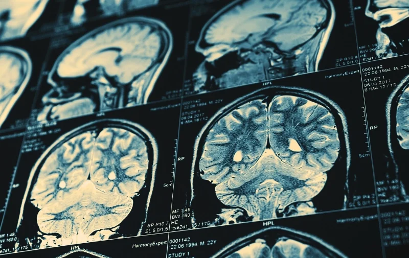 Collection of human brain MRI scans on a monitor.